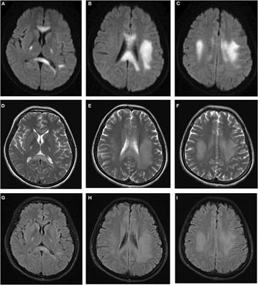 Recurrent Stroke-Like Symptoms After Cesarean Section Deliveries in a Female Patient With X-Linked Charcot-Marie-Tooth Type 1